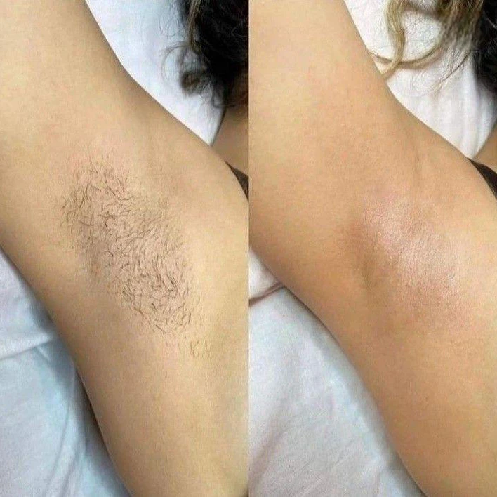 Laser hair removal · 4 visits