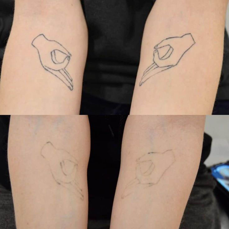 Tattoo removal · 5 visits
