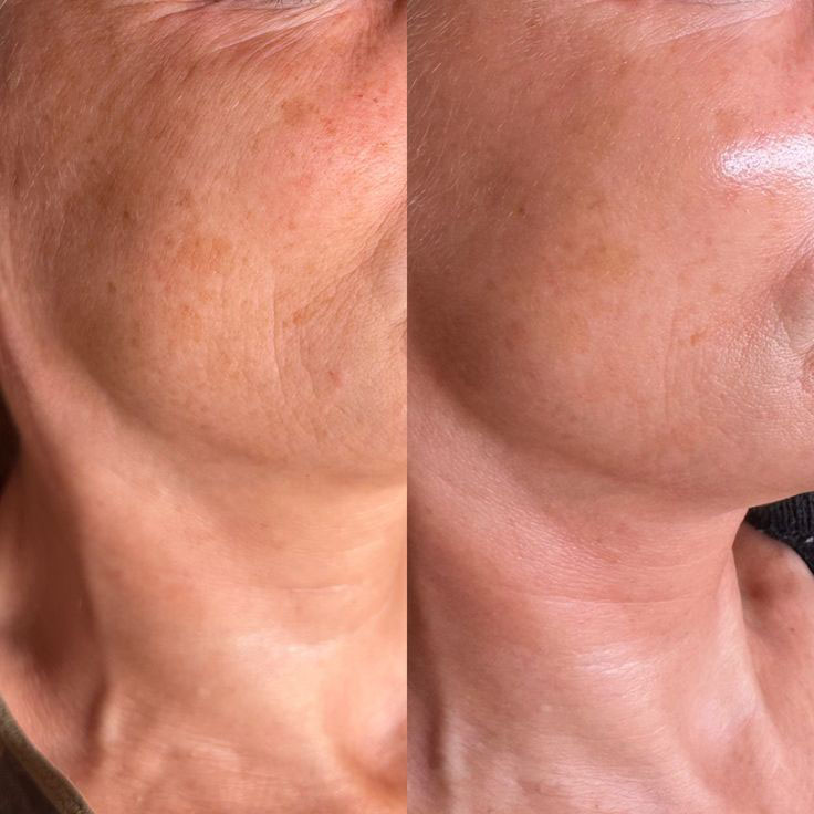 RF lifting face · 5 visits